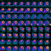 Pet-Scan