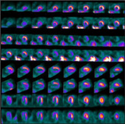SPECT-scan